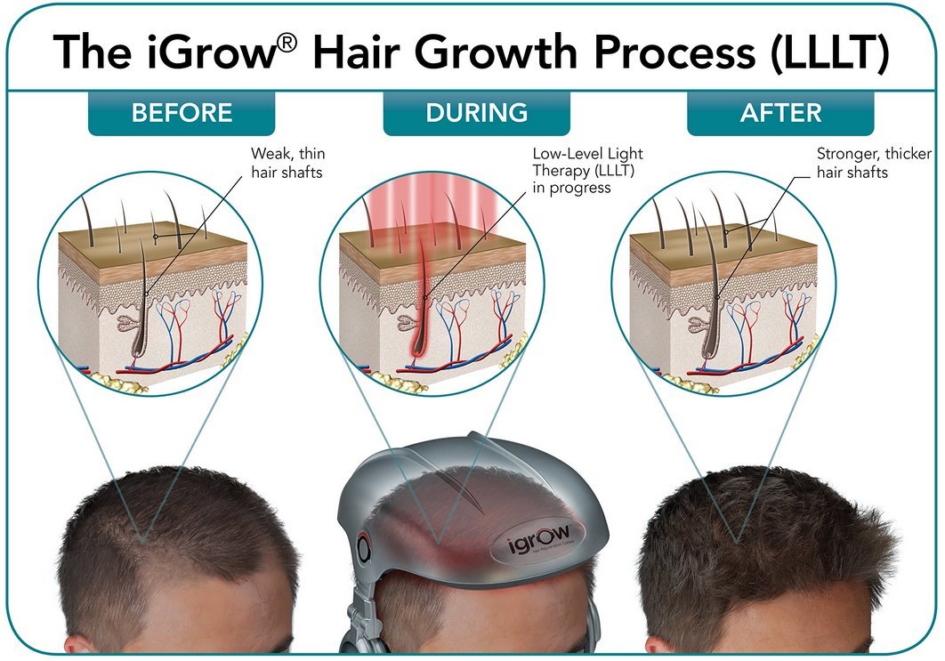 laser hair regrowth treatment reviews