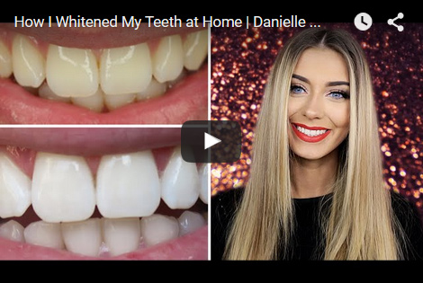 la smile teeth whitening reviews